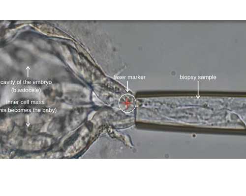 试管代怀子,附件炎会影响怀孕吗