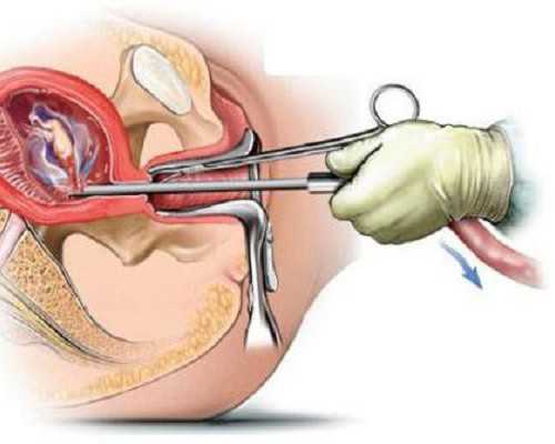 代生套餐,宫腔镜检查显示子宫内膜炎有息肉下个月可以促排